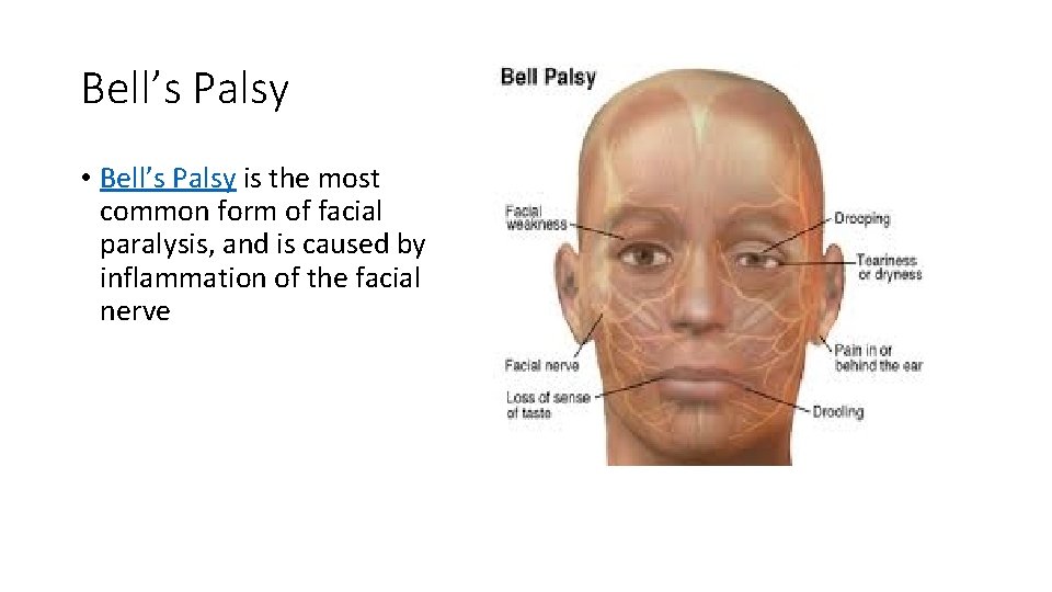 Bell’s Palsy • Bell’s Palsy is the most common form of facial paralysis, and