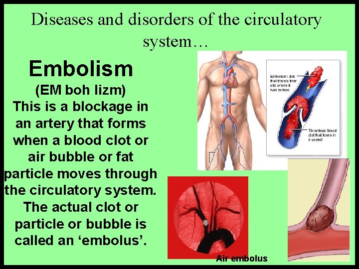 Diseases and disorders of the circulatory system… Embolism (EM boh lizm) This is a Diseases and disorders of the circulatory system… Embolism (EM boh lizm) This is a