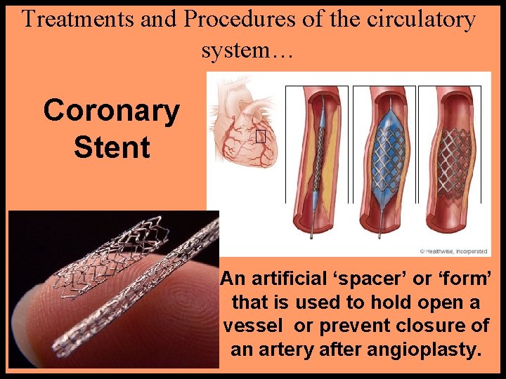 Treatments and Procedures of the circulatory system… Coronary Stent An artificial ‘spacer’ or ‘form’ Treatments and Procedures of the circulatory system… Coronary Stent An artificial ‘spacer’ or ‘form’