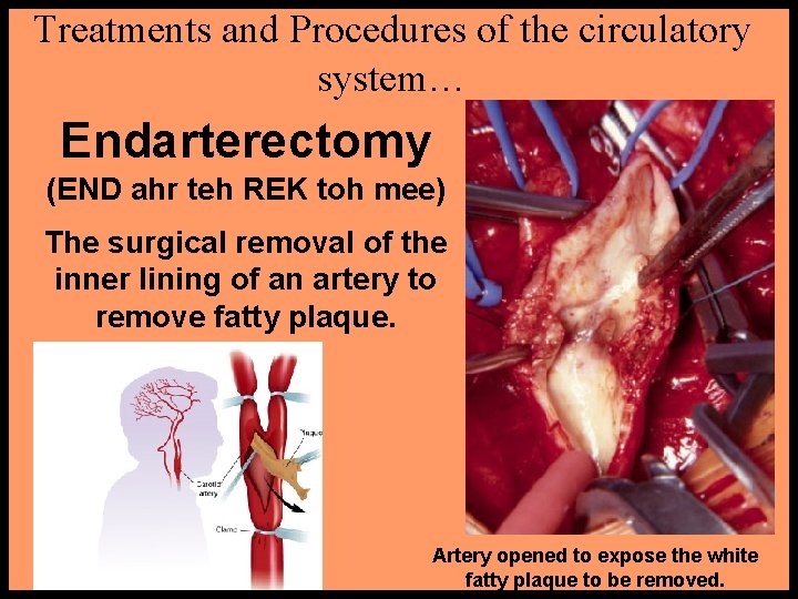 Treatments and Procedures of the circulatory system… Endarterectomy (END ahr teh REK toh mee) Treatments and Procedures of the circulatory system… Endarterectomy (END ahr teh REK toh mee)