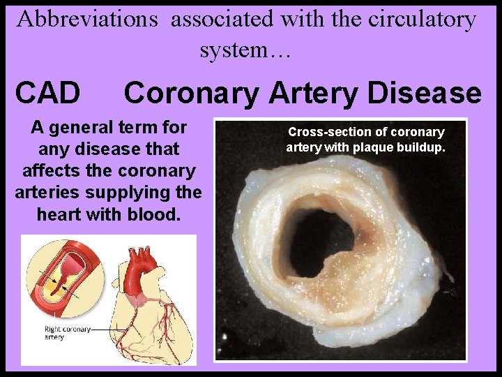 Abbreviations associated with the circulatory system… CAD Coronary Artery Disease A general term for Abbreviations associated with the circulatory system… CAD Coronary Artery Disease A general term for