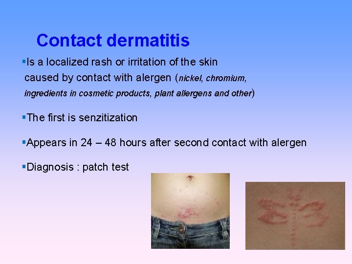 Contact dermatitis Is a localized rash or irritation of the skin caused by contact