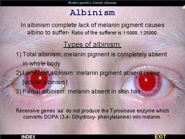 Modern genetics: Genetic diseases. Albinism In albinism complete lack of melanin pigment causes albino