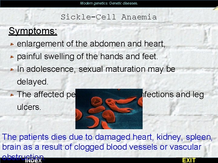Modern genetics: Genetic diseases. Sickle-Cell Anaemia Symptoms: enlargement of the abdomen and heart, painful
