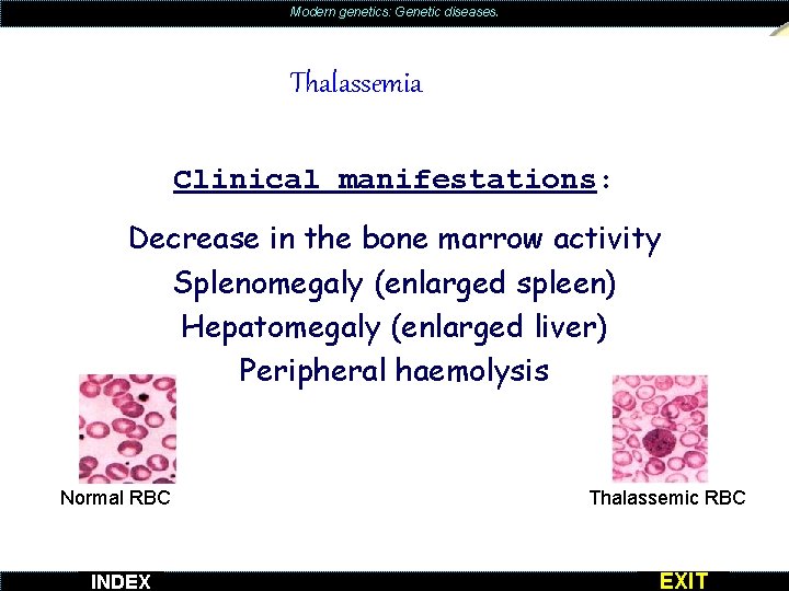 Modern genetics: Genetic diseases. Thalassemia Clinical manifestations: Decrease in the bone marrow activity Splenomegaly