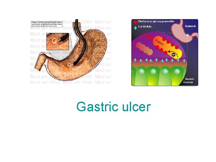Gastric ulcer 