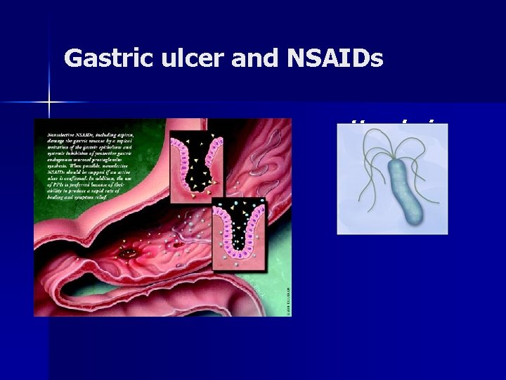 Gastric ulcer and NSAIDs n infection H. pylori 