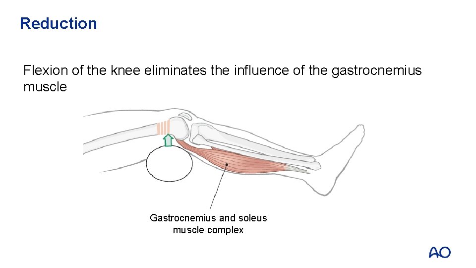 Reduction Flexion of the knee eliminates the influence of the gastrocnemius muscle Gastrocnemius and