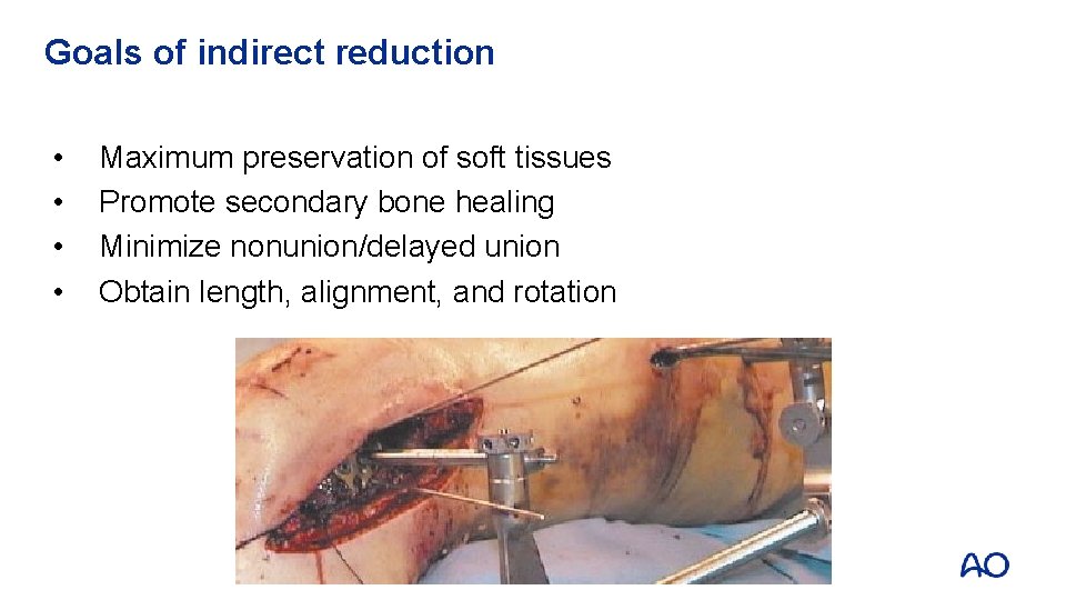 Goals of indirect reduction • • Maximum preservation of soft tissues Promote secondary bone