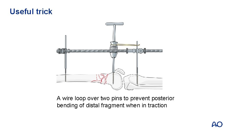 Useful trick A wire loop over two pins to prevent posterior bending of distal