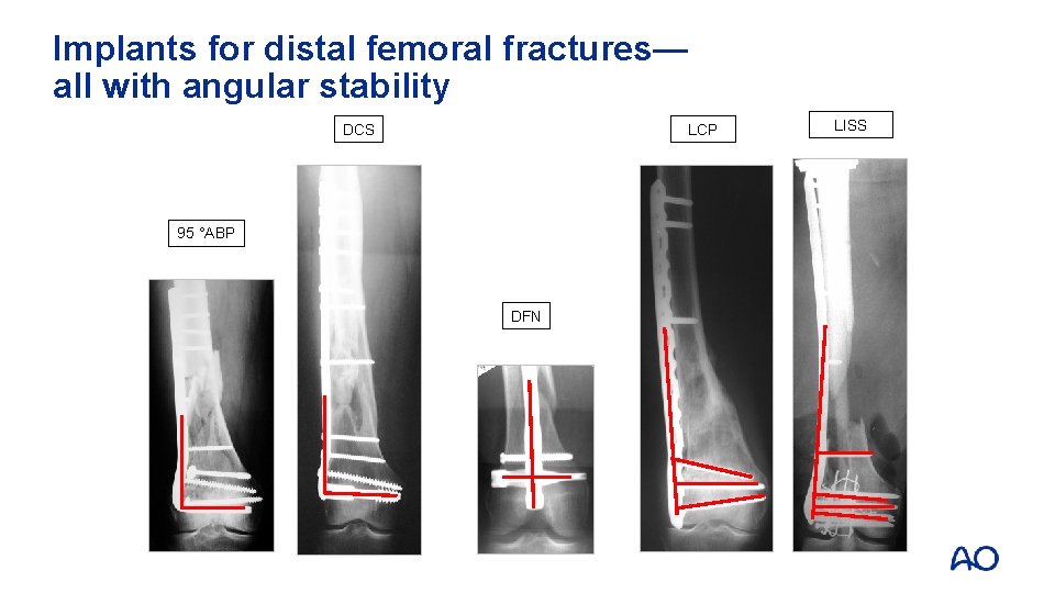 Implants for distal femoral fractures— all with angular stability DCS LCP 95 °ABP DFN