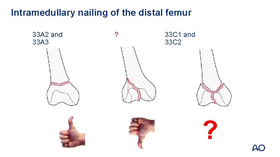 Intramedullary nailing of the distal femur 33 A 2 and 33 A 3 ?
