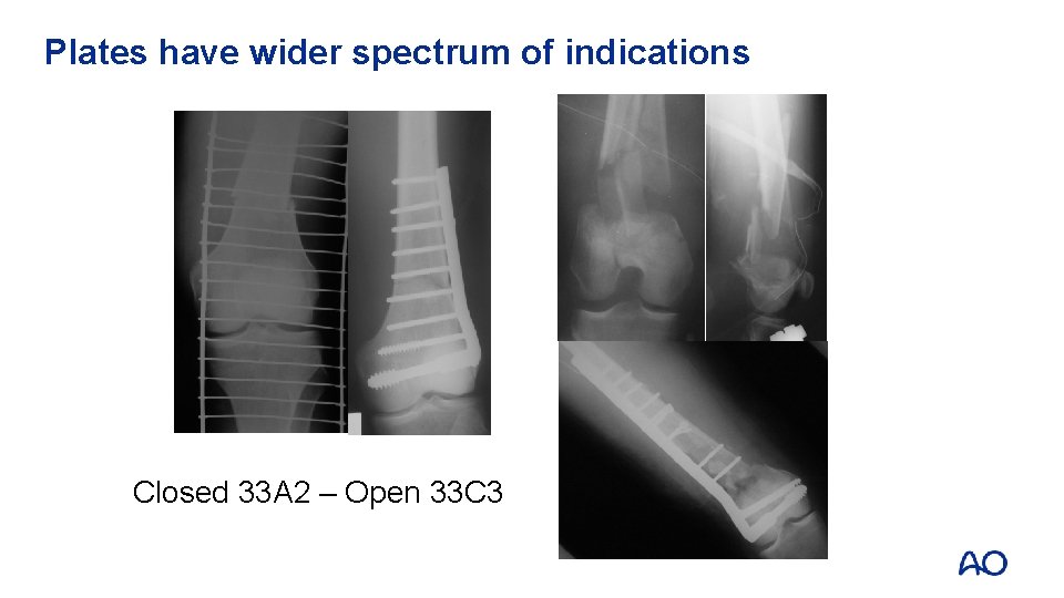 Plates have wider spectrum of indications Closed 33 A 2 – Open 33 C