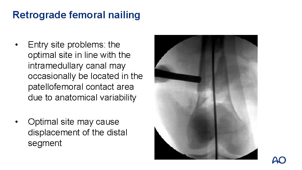 Retrograde femoral nailing • Entry site problems: the optimal site in line with the