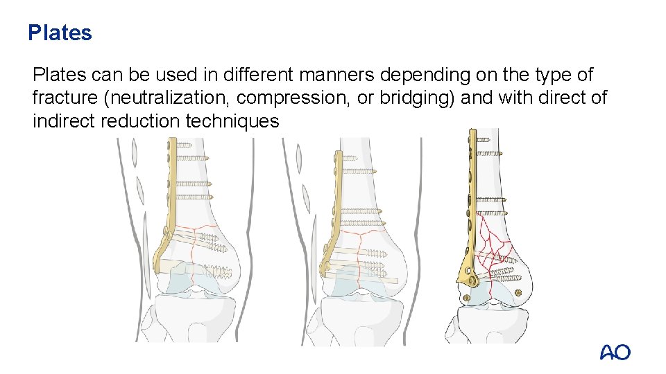 Plates can be used in different manners depending on the type of fracture (neutralization,