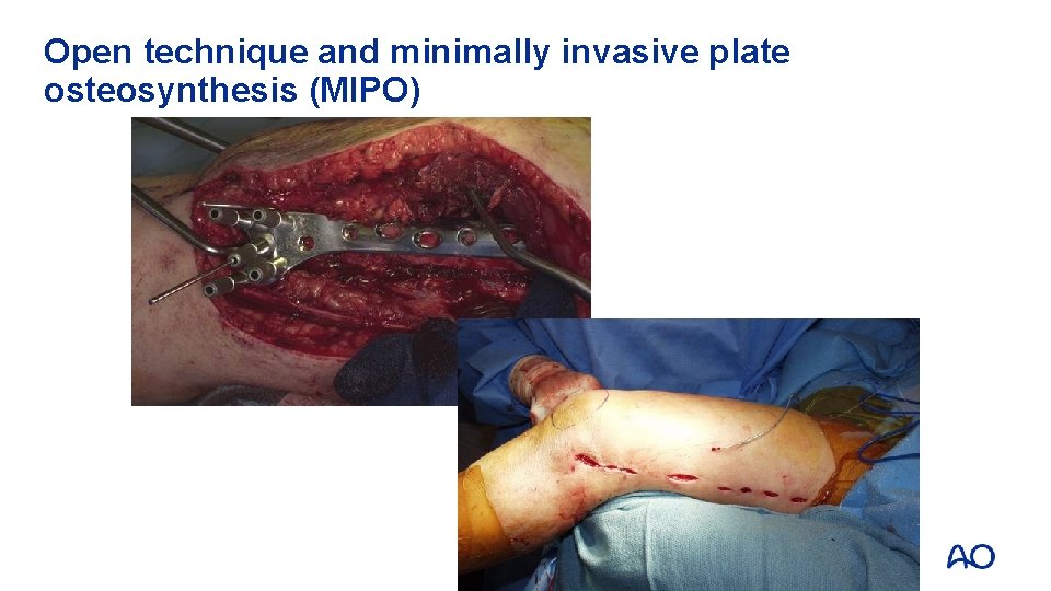 Open technique and minimally invasive plate osteosynthesis (MIPO) 