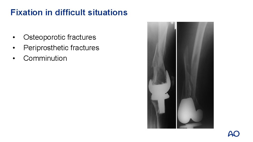 Fixation in difficult situations • • • Osteoporotic fractures Periprosthetic fractures Comminution 