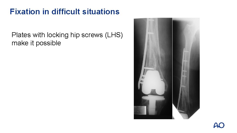 Fixation in difficult situations Plates with locking hip screws (LHS) make it possible 