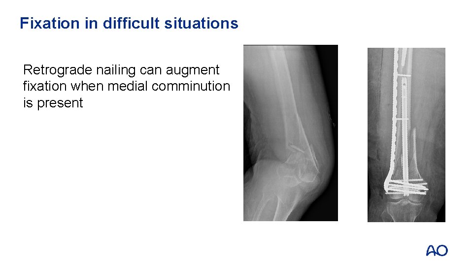 Fixation in difficult situations Retrograde nailing can augment fixation when medial comminution is present