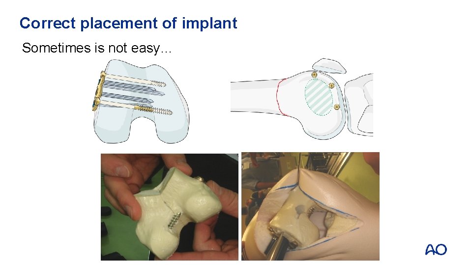 Correct placement of implant Sometimes is not easy… 