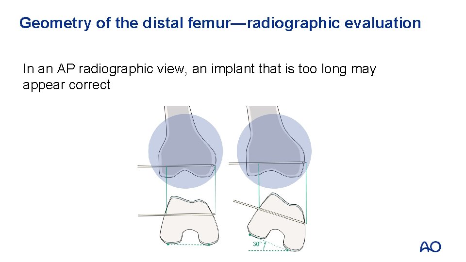 Geometry of the distal femur—radiographic evaluation In an AP radiographic view, an implant that