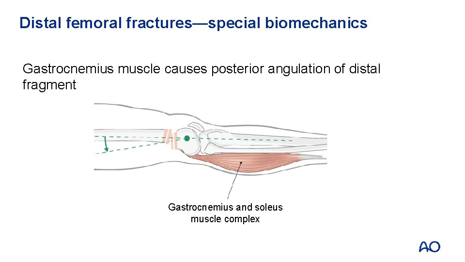 Distal femoral fractures—special biomechanics Gastrocnemius muscle causes posterior angulation of distal fragment Gastrocnemius and