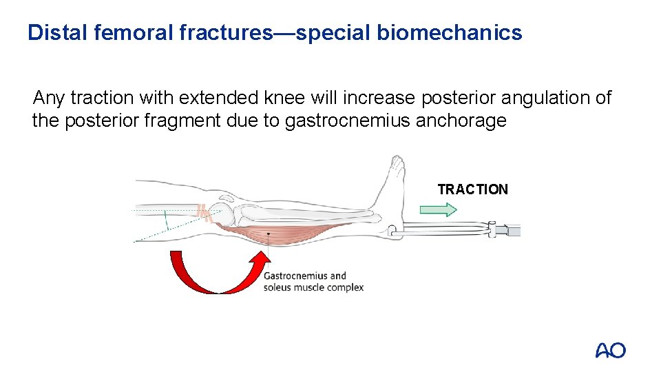 Distal femoral fractures—special biomechanics Any traction with extended knee will increase posterior angulation of