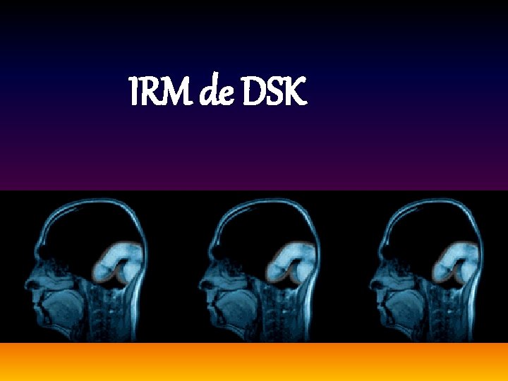 IRM de DSK 