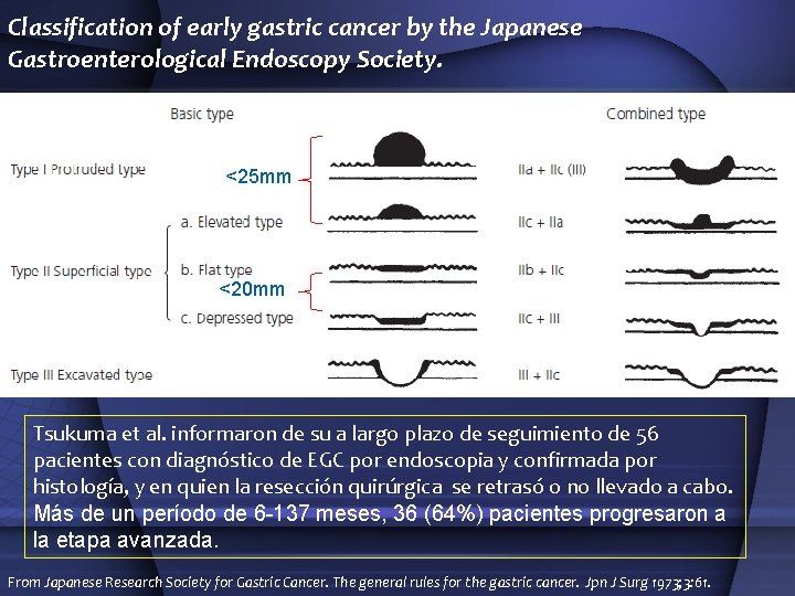 Classification of early gastric cancer by the Japanese Gastroenterological Endoscopy Society. <25 mm <20