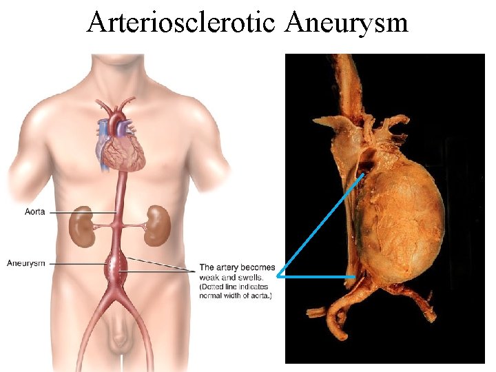 Arteriosclerotic Aneurysm 