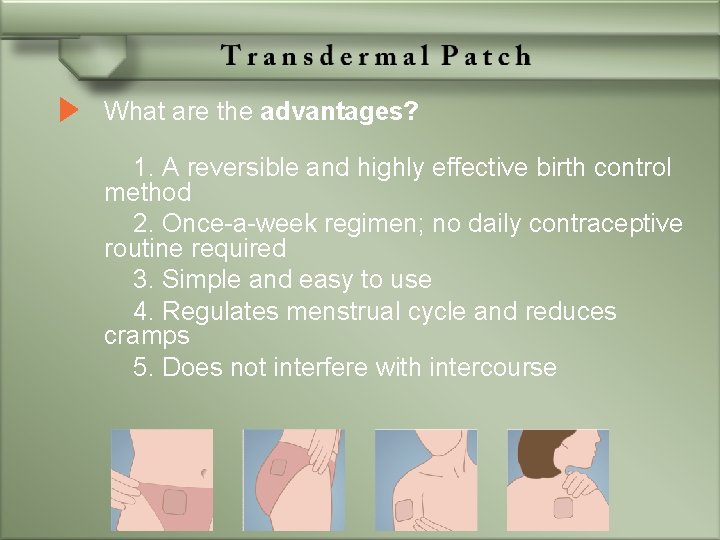What are the advantages? 1. A reversible and highly effective birth control method 2.