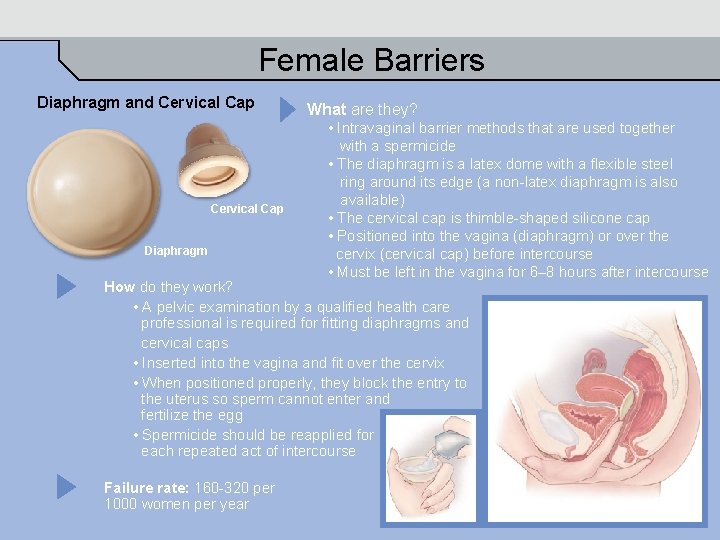 Female Barriers Diaphragm and Cervical Cap Diaphragm What are they? • Intravaginal barrier methods