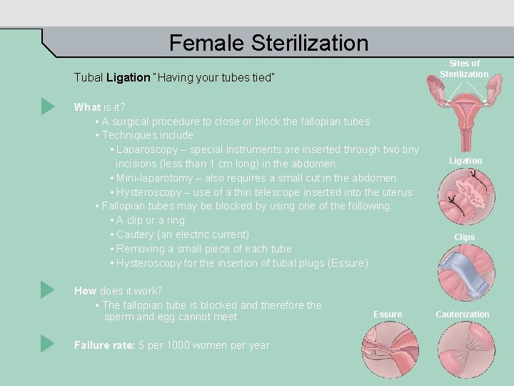 Female Sterilization Sites of Sterilization Tubal Ligation “Having your tubes tied” What is it?
