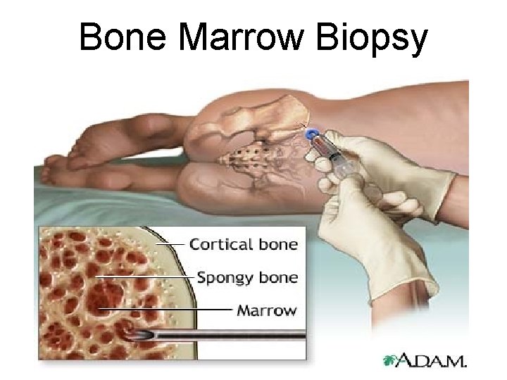 Bone Marrow Biopsy 