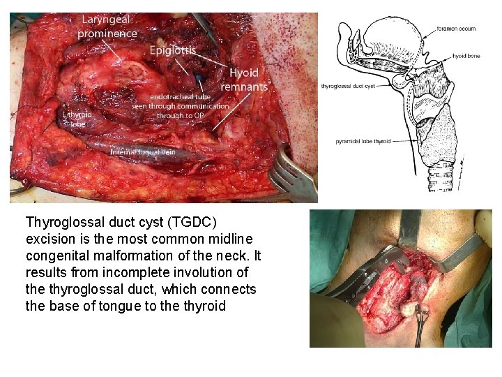 Thyroglossal duct cyst (TGDC) excision is the most common midline congenital malformation of the