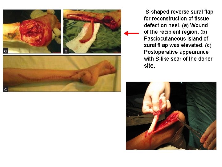 S-shaped reverse sural flap for reconstruction of tissue defect on heel. (a) Wound of