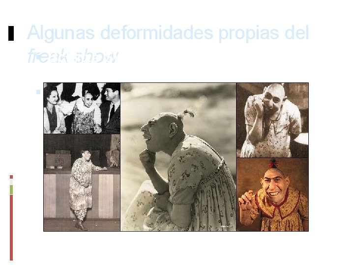 Algunas deformidades propias del Schlitze Surtees, Schlitzie: freak show Microcefalia 