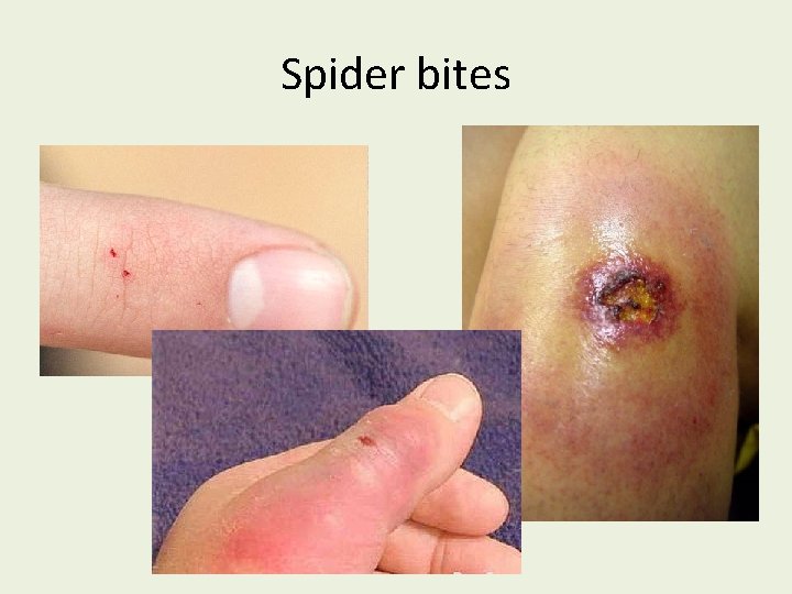 Spider bites 