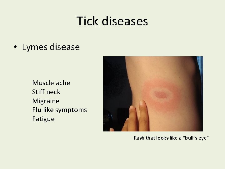 Tick diseases • Lymes disease Muscle ache Stiff neck Migraine Flu like symptoms Fatigue