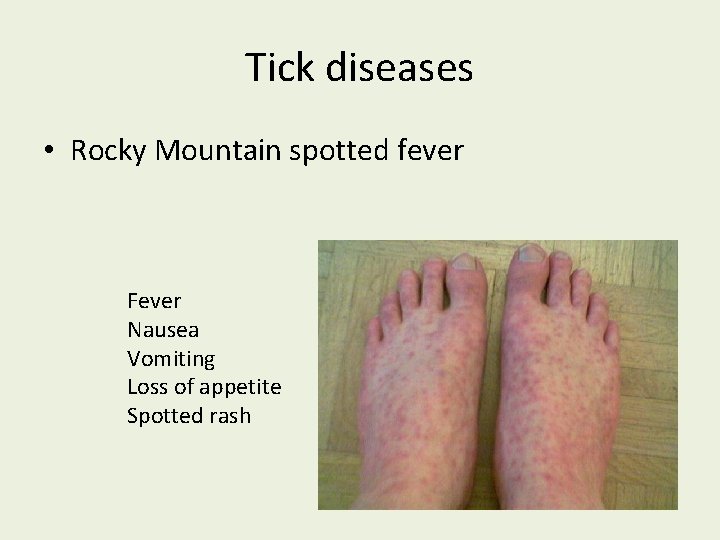 Tick diseases • Rocky Mountain spotted fever Fever Nausea Vomiting Loss of appetite Spotted