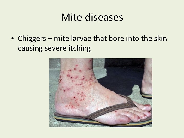 Mite diseases • Chiggers – mite larvae that bore into the skin causing severe