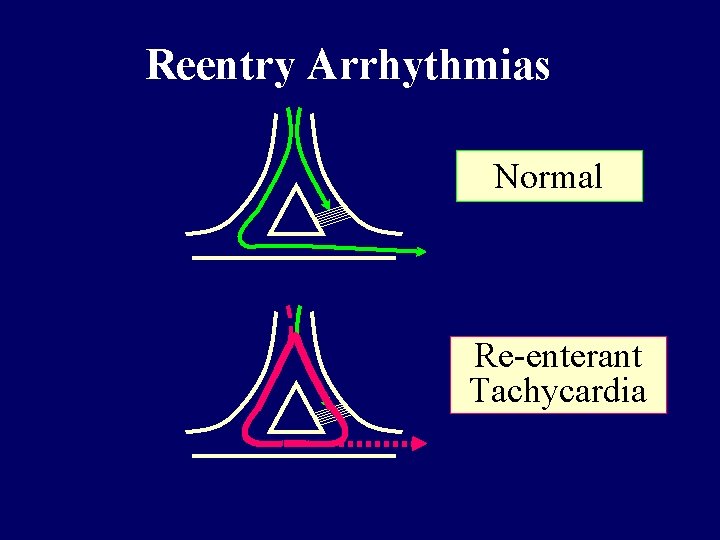 Reentry Arrhythmias Normal Re-enterant Tachycardia 