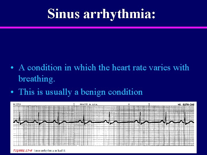 Sinus arrhythmia: • A condition in which the heart rate varies with breathing. •