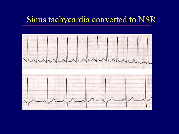 Sinus tachycardia converted to NSR 