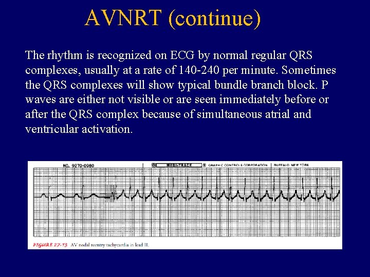 AVNRT (continue) The rhythm is recognized on ECG by normal regular QRS complexes, usually