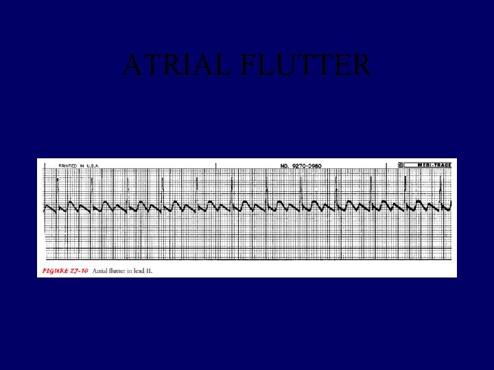 ATRIAL FLUTTER 