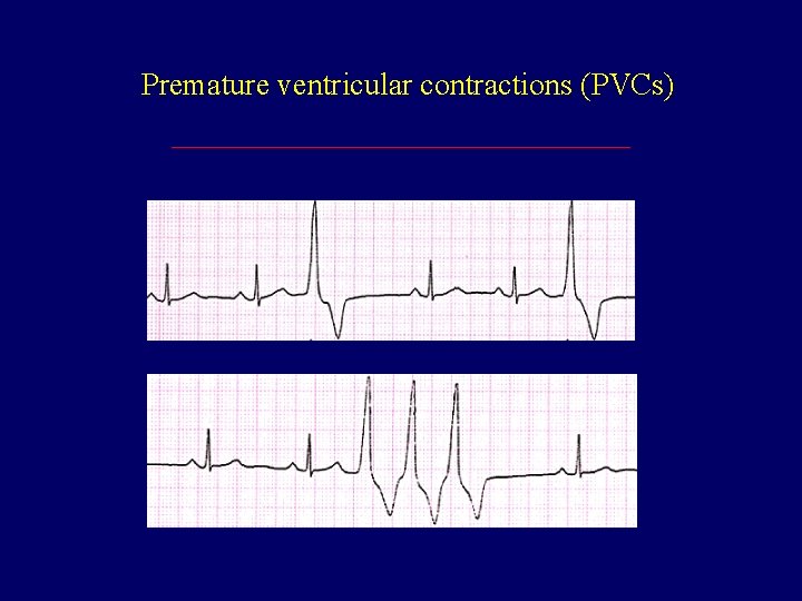 Premature ventricular contractions (PVCs) 