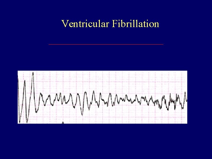 Ventricular Fibrillation 