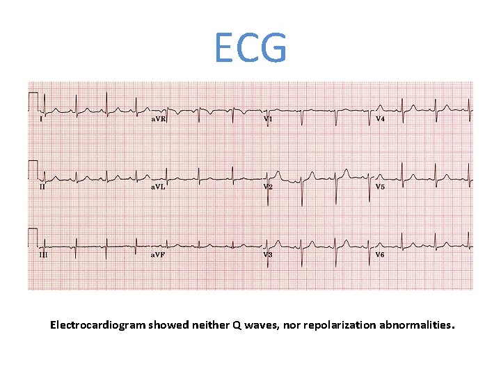ECG Electrocardiogram showed neither Q waves, nor repolarization abnormalities. 