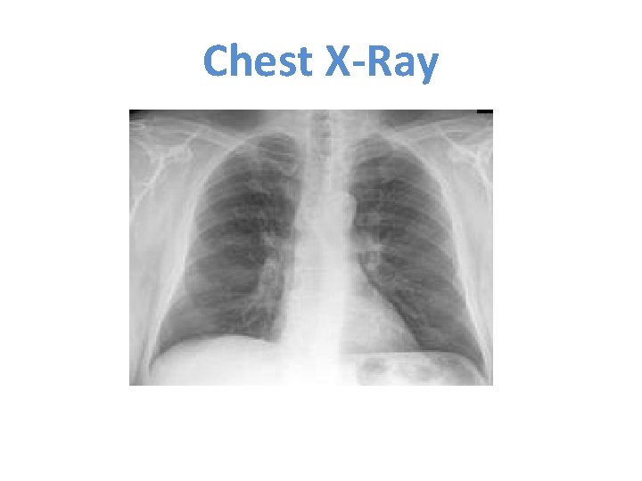 Chest X-Ray 